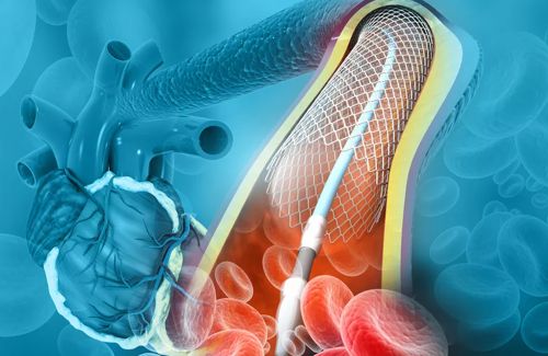O que são o cateterismo cardíaco e angioplastia